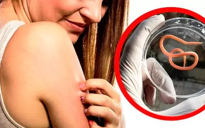 ქავილი და გაღიზიანება ორგანიზმში არსებული პარაზიტების გამო